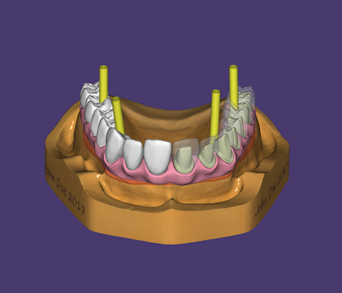 Implant Planning & Guided Surgery